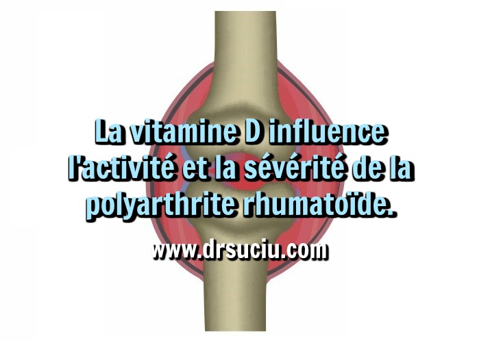 Photo drsuciu Le lien entre la vitamine D et la polyarthrite rhumatoïde